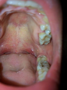 喉咙痒了一个月肺癌:警惕!喉咙痒一个月可能是肺癌信号,这些症状需重视 喉咙痒了一个月肺癌:警惕!喉咙痒一个月可能是肺癌信号,这些症状需重视