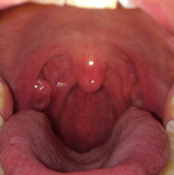 喉咙痒了一个月肺癌：警惕！喉咙痒一个月可能是肺癌信号，这些症状需重视