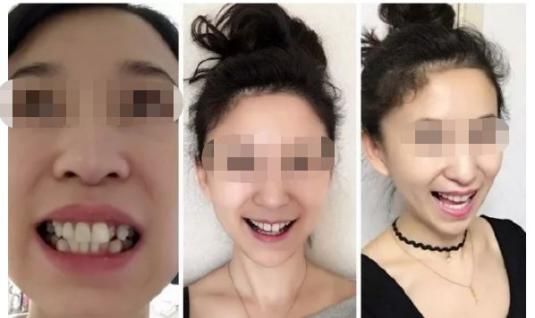 成年以后千万别整牙：成年后千万别整牙，你真的需要矫正牙齿吗？