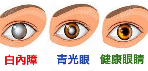 矫正近视眼手术费用:矫正近视眼手术费用到底多少钱?看完这篇你就懂了! 矫正近视眼手术费用:矫正近视眼手术费用到底多少钱?看完这篇你就懂了!