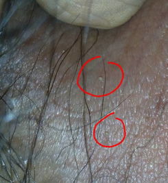 尖疣早期和珍珠疹图片：尖疣早期和珍珠疹傻傻分不清？这些特征帮你一眼识别！