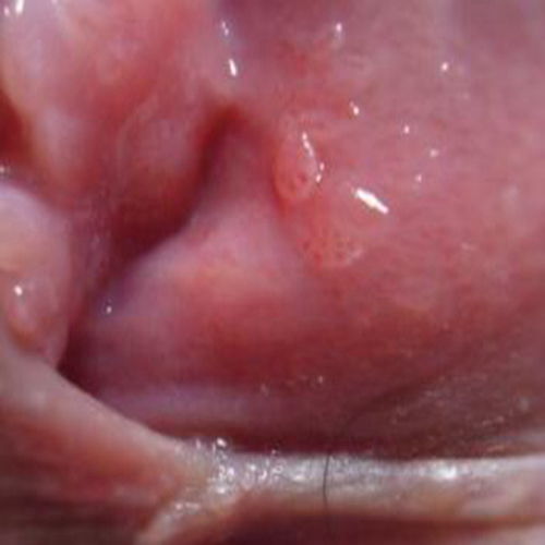 尖疣早期和珍珠疹图片：尖疣早期和珍珠疹傻傻分不清？这些特征帮你一眼识别！