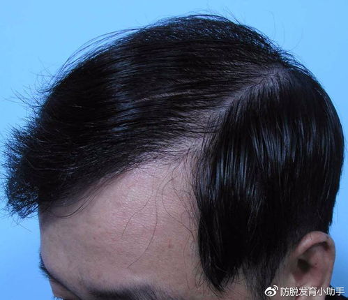 头发稀疏还能长回来吗：头发稀疏还能长回来吗？答案在这里！