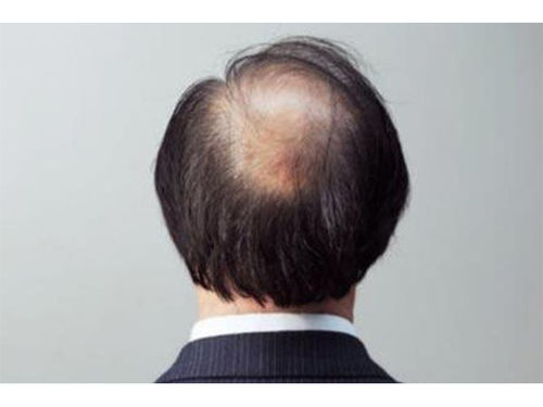 头发稀疏还能长回来吗：头发稀疏还能长回来吗？答案在这里！