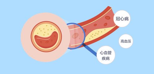 胆固醇高的原因：胆固醇高？这些原因你中招了吗？