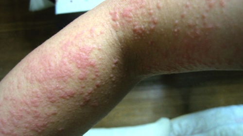 湿疹是什么引起的:揭秘湿疹的成因,为什么皮肤会变得又红又痒? 湿疹是什么引起的:揭秘湿疹的成因,为什么皮肤会变得又红又痒?