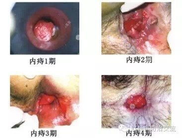 痔疮怎么治好得快又有效：告别疼痛！痔疮快速有效治疗指南，这些方法值得一试