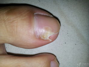 伊曲康唑治疗灰指甲多久见效:伊曲康唑治疗灰指甲多久见效? 伊曲康唑治疗灰指甲多久见效:伊曲康唑治疗灰指甲多久见效?