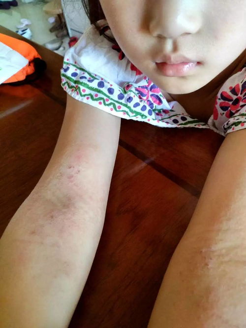 捂出来的湿疹怎么处理：别再犯了！捂出来的湿疹这样处理，湿疹不再困扰你！