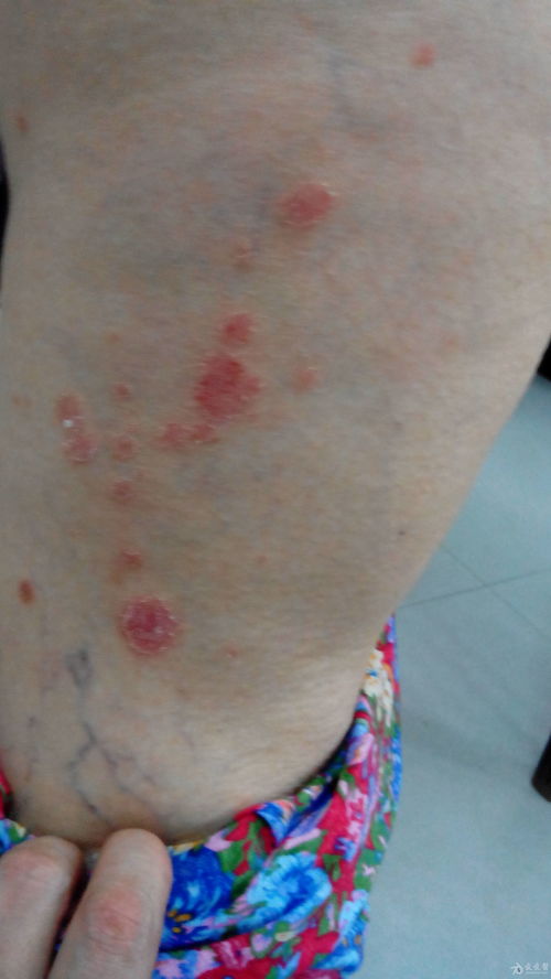 皮肤出现红斑图片:皮肤出现红斑图片,识别与应对指南 皮肤出现红斑图片:皮肤出现红斑图片,识别与应对指南