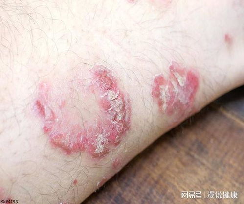 皮肤出现红斑图片:皮肤出现红斑图片,识别与应对指南 皮肤出现红斑图片:皮肤出现红斑图片,识别与应对指南