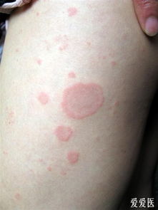皮肤出现红斑图片:皮肤出现红斑图片,识别与应对指南 皮肤出现红斑图片:皮肤出现红斑图片,识别与应对指南
