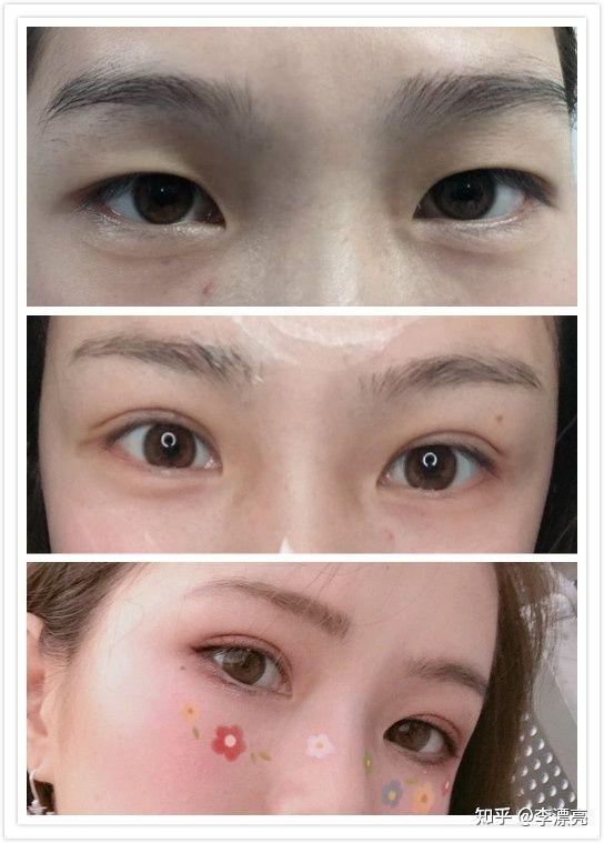 郑州割双眼皮最好的正规医院:郑州割双眼皮哪家正规医院好?2023年权威推荐TOP榜单