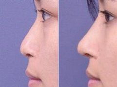 隆鼻手术整形美容医院:选择隆鼻手术整形美容医院的五大关键点 隆鼻手术整形美容医院:选择隆鼻手术整形美容医院的五大关键点