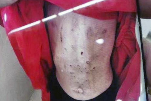 肚子打了溶脂针9天了:肚子打了溶脂针9天了,效果到底怎么样? 肚子打了溶脂针9天了:肚子打了溶脂针9天了,效果到底怎么样?