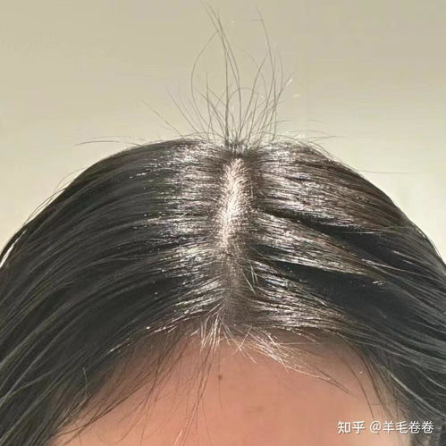 怎么让头发越来越多:头发越来越少?这些科学方法或可助你生新发