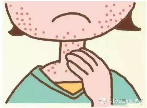 皮肤过敏图片真实:真实皮肤过敏图片大公开,这些症状你中招了吗? 皮肤过敏图片真实:真实皮肤过敏图片大公开,这些症状你中招了吗?