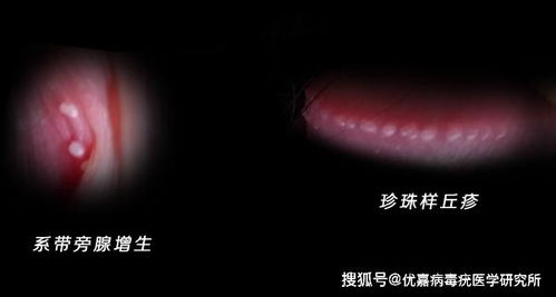 珍珠疹和尖锐湿区分图片：珍珠疹与尖锐湿疣，外观相似但性质迥异的生殖器周围皮肤问题