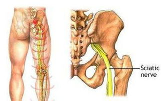 坐骨神经痛的特效药：坐骨神经痛的特效药？专家，缓解有方，但需辨证施治