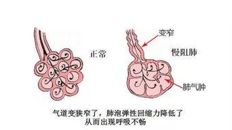 慢阻肺是一种什么病:认识慢阻肺,呼吸系统的沉默挑战者 慢阻肺是一种什么病:认识慢阻肺,呼吸系统的沉默挑战者
