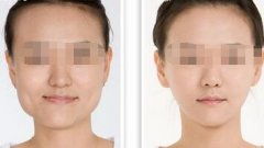 整下巴大概需要多少钱：整下巴手术价格解析，影响因素、费用范围及注意事项