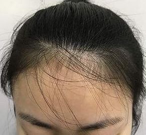 梦见别人掉头发:解密梦境,为何梦见别人掉头发?