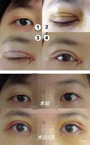 上眼皮抽脂大概多少钱:上眼皮抽脂价格参考,了解费用构成与选择正规机构的重要性 上眼皮抽脂大概多少钱:上眼皮抽脂价格参考,了解费用构成与选择正规机构的重要性