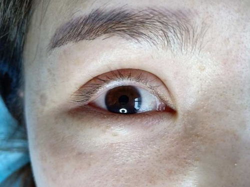 上眼皮抽脂大概多少钱：上眼皮抽脂价格参考，了解费用构成与选择正规机构的重要性