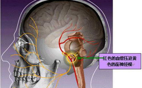 乐瑞卡吃多久能治好神经痛:乐瑞卡治疗神经痛的疗程解析,多久能有效管理? 乐瑞卡吃多久能治好神经痛:乐瑞卡治疗神经痛的疗程解析,多久能有效管理?