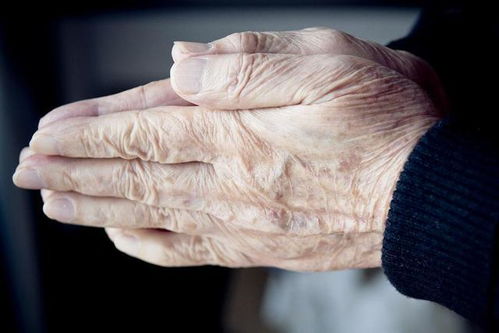 长老年斑了怎么办:长老年斑了怎么办?这些方法或许能帮到你 长老年斑了怎么办:长老年斑了怎么办?这些方法或许能帮到你