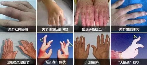 类风湿如何能治好:类风湿性关节炎,最新治疗进展与科学管理策略 类风湿如何能治好:类风湿性关节炎,最新治疗进展与科学管理策略