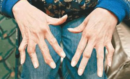 类风湿如何能治好:类风湿性关节炎,最新治疗进展与科学管理策略 类风湿如何能治好:类风湿性关节炎,最新治疗进展与科学管理策略