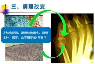 类风湿如何能治好:类风湿性关节炎,最新治疗进展与科学管理策略 类风湿如何能治好:类风湿性关节炎,最新治疗进展与科学管理策略