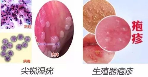 男性尖锐湿尤图图片:男性尖锐湿疣,认识与防治 男性尖锐湿尤图图片:男性尖锐湿疣,认识与防治