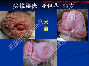 男性尖锐湿尤图图片：男性尖锐湿疣，认识与防治