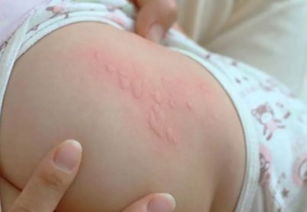 孩子全身突然起大片大片的红:孩子全身突然起大片红疹?警惕这些原因并及时应对! 孩子全身突然起大片大片的红:孩子全身突然起大片红疹?警惕这些原因并及时应对!