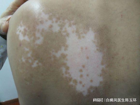 白点癫风的初期可以治好吗:白点癫风的初期可以治好吗? 白点癫风的初期可以治好吗:白点癫风的初期可以治好吗?