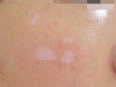 白点癫风的初期可以治好吗：白点癫风的初期可以治好吗？