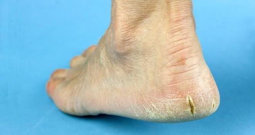 脚后跟干裂起硬皮怎么办:脚后跟干裂起硬皮怎么办?5个实用方法让你告别疼痛 脚后跟干裂起硬皮怎么办:脚后跟干裂起硬皮怎么办?5个实用方法让你告别疼痛