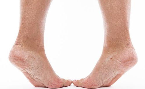 脚后跟干裂起硬皮怎么办：脚后跟干裂起硬皮怎么办？5个实用方法让你告别疼痛