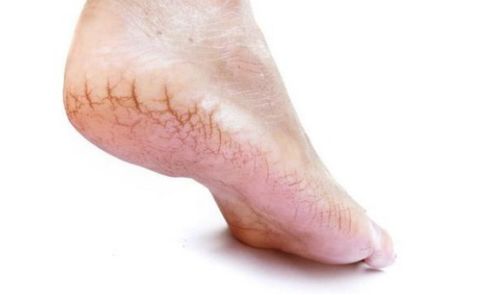 脚后跟干裂起硬皮怎么办:脚后跟干裂起硬皮怎么办?5个实用方法让你告别疼痛 脚后跟干裂起硬皮怎么办:脚后跟干裂起硬皮怎么办?5个实用方法让你告别疼痛