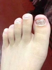 灰指甲长什么样子图片:灰指甲长什么样子?图解灰指甲典型症状与特征 灰指甲长什么样子图片:灰指甲长什么样子?图解灰指甲典型症状与特征