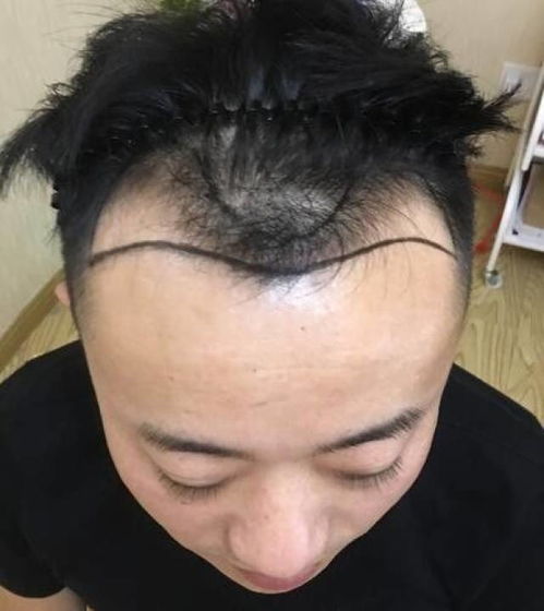 头顶头发稀少怎么补救:头顶头发稀少怎么补救?这些方法帮你重拾浓密秀发! 头顶头发稀少怎么补救:头顶头发稀少怎么补救?这些方法帮你重拾浓密秀发!