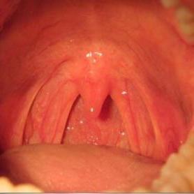 喉咙发炎吃什么药:喉咙发炎吃什么药?对症下药缓解不适 喉咙发炎吃什么药:喉咙发炎吃什么药?对症下药缓解不适