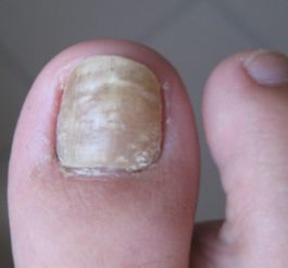 不严重的灰指甲图片:灰指甲初期症状,如何识别不严重的灰指甲? 不严重的灰指甲图片:灰指甲初期症状,如何识别不严重的灰指甲?