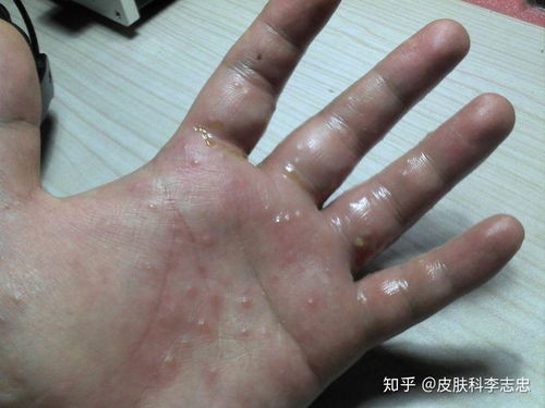 水泡的正确处理方法:水泡了怎么办?这些处理方法请收好! 水泡的正确处理方法:水泡了怎么办?这些处理方法请收好!