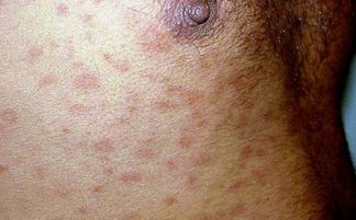 疥疮的症状图片:疥疮的症状图片详解,从典型表现到常见误区 疥疮的症状图片:疥疮的症状图片详解,从典型表现到常见误区