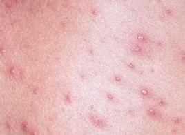 疥疮的症状图片:疥疮的症状图片详解,从典型表现到常见误区 疥疮的症状图片:疥疮的症状图片详解,从典型表现到常见误区