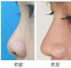 鼻子综合整形多少钱了：鼻子整形费用全面分析，综合鼻整形价格参考指南