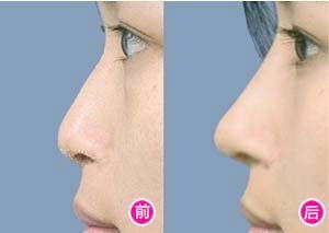 鼻子综合整形多少钱了：鼻子整形费用全面分析，综合鼻整形价格参考指南